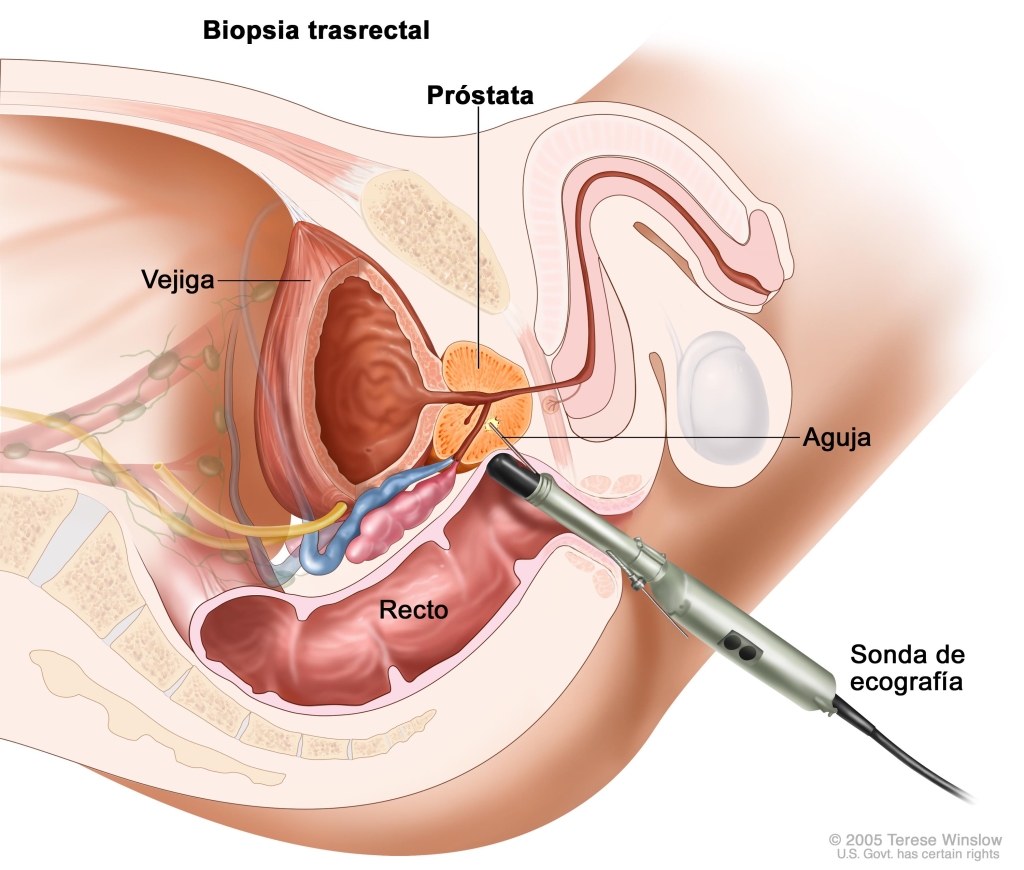 Biopsia Transrectal de Próstata