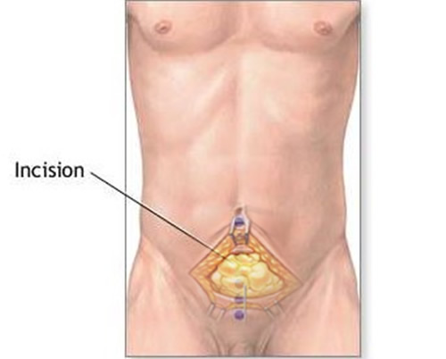 Cirugía Radical de Próstata, Prostatectomía Radical 