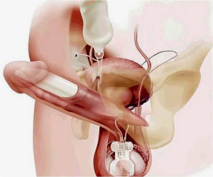 Lee más sobre el artículo Recuperación más rápida con la implantación infrapúbica de prótesis de pene