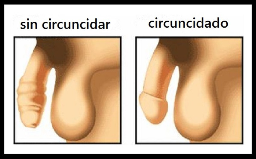 Cirugia de Circuncisión