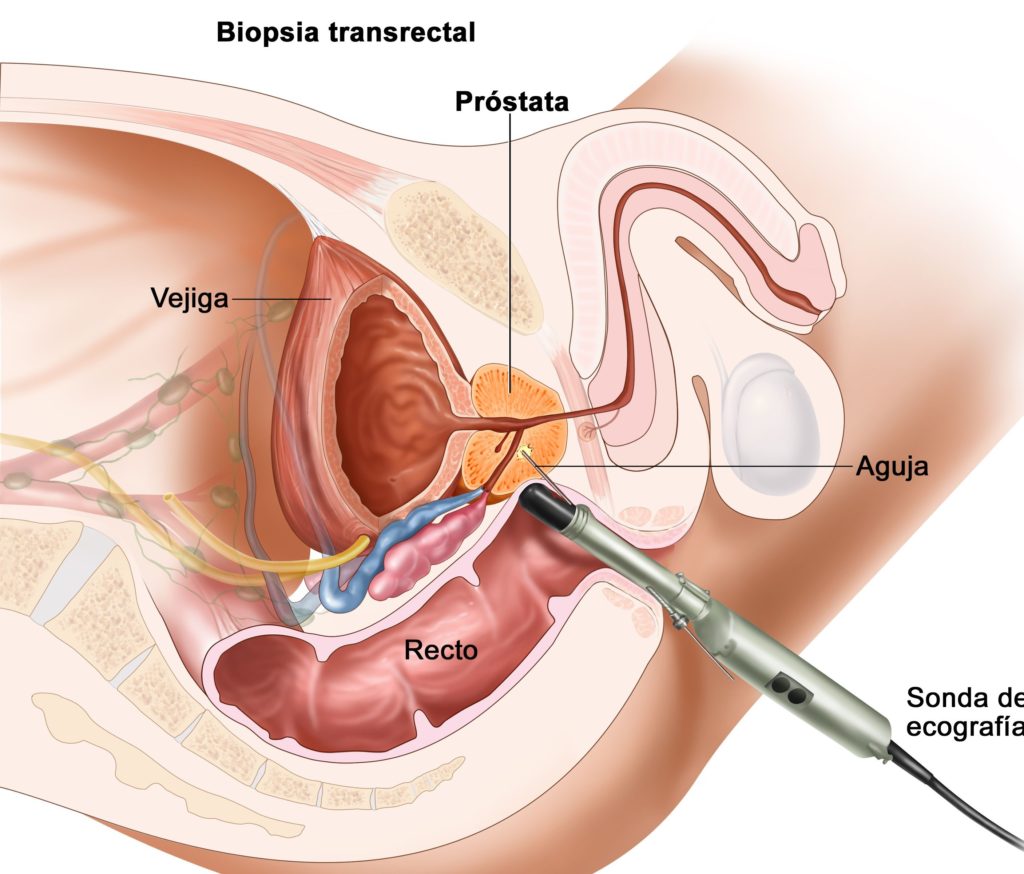 Biopsia de Próstata, urologo en santa cruz